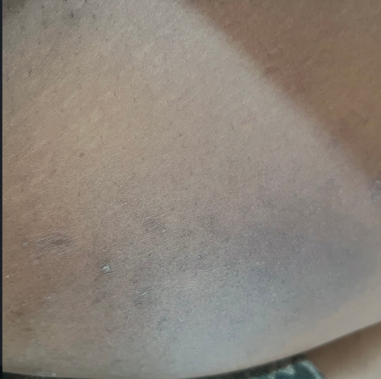 Dark inner thigh Kit (Routine bundle)